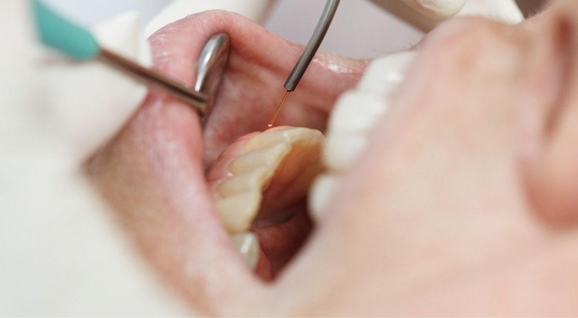 レーザー治療器で歯科治療をしている写真